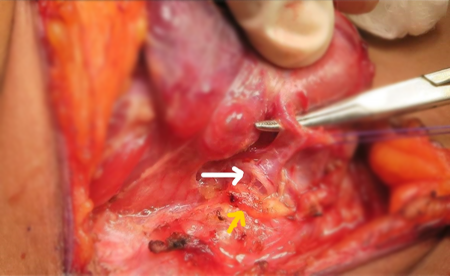 Thyroid Surgery in India